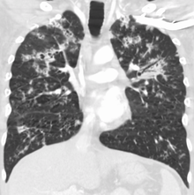 Obraz płuc po zarażeniu prątkami gruźlicy. Mycobacterium tuberculosis – prątkiem gruźlicy