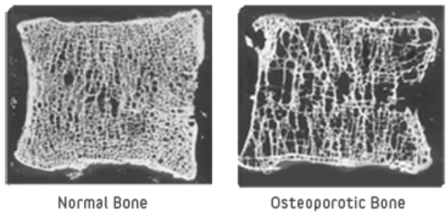 Na powyższej grafice widoczne jest porównanie w przekroju zdrowej kości, a kości u osoby chorującej na osteoporozę. Widoczne są zwiększone otwory w tkance, związane z jej ubytkiem.