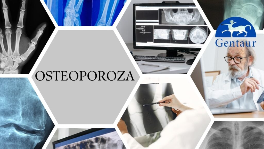 Osteoporoza - choroba osób nie tylko w starszym wieku • Spadek wzrostu – stopniowy ubytek centymetrów • Zmiany w posturze – osoba zaczyna pochylać się, garbić • Duszność – poprzez zwiększony nacisk kręgów zmniejsza się pojemność płuc • Uszkodzenia kości • Ból w dolnej części pleców