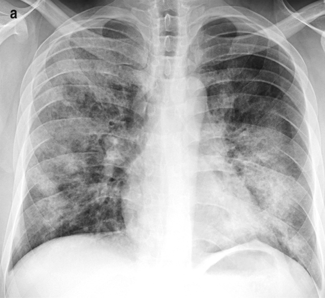 Rentgen_odoskrzelowego zapalenia płuc
